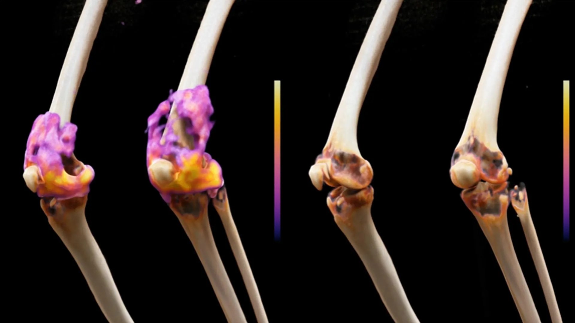 CAR T Cells Put Arthritis in Remission