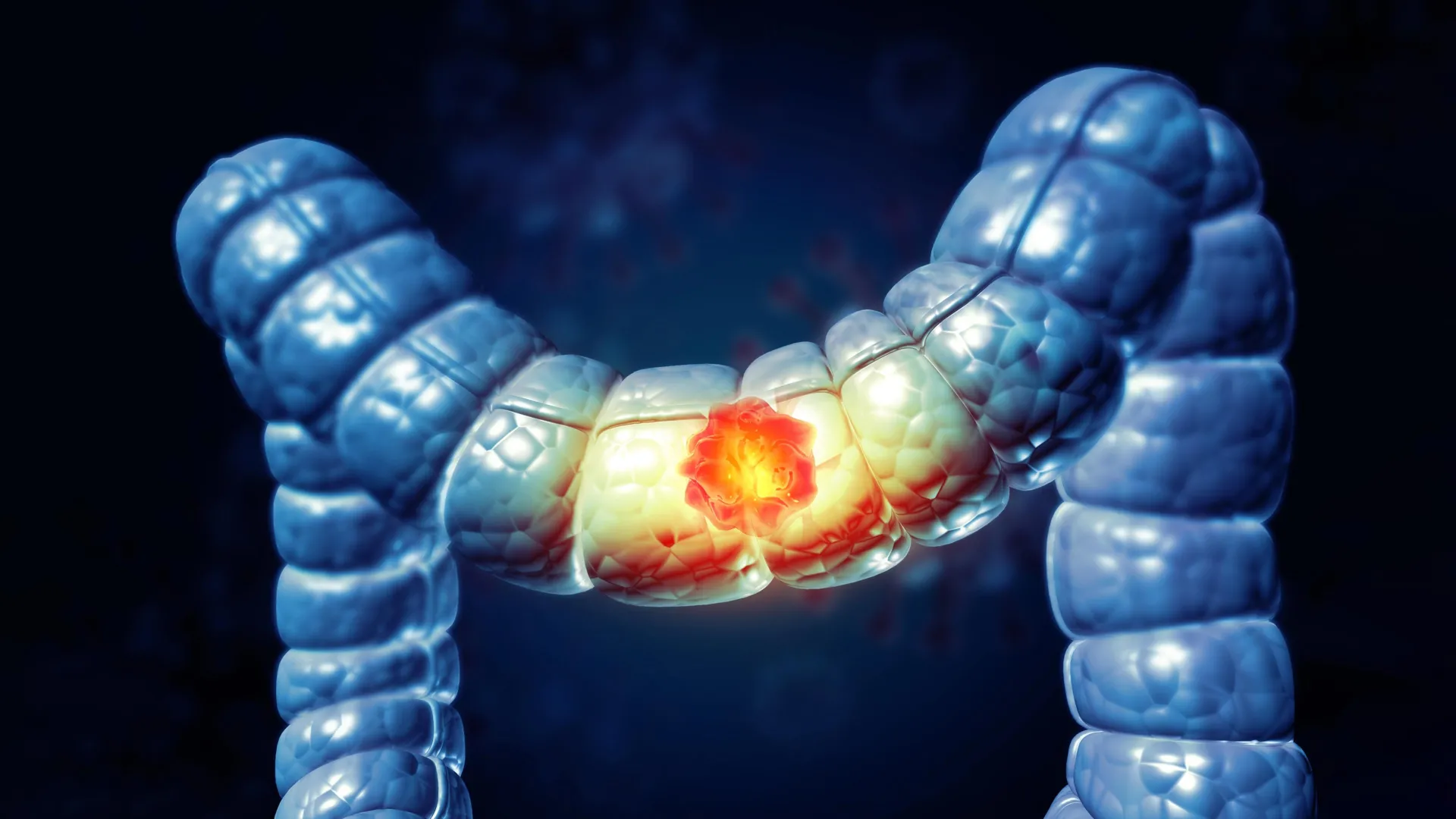 A Stiffening Colon May Be Fueling Cancer