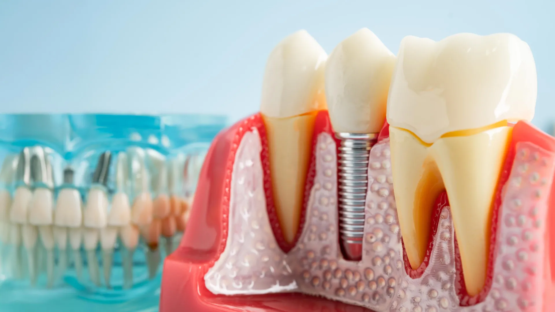 Dental Implants Can Hijack Immune System