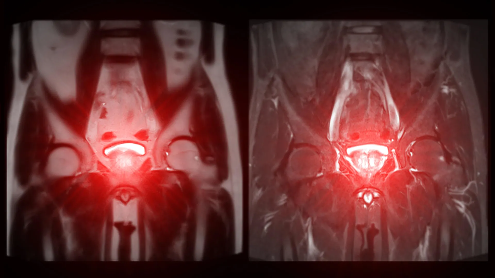How Prostate Cancer May Begin