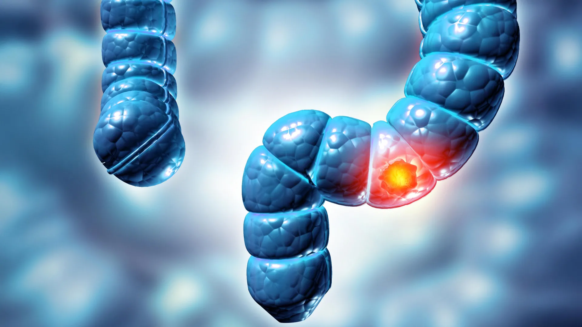 Hidden Bowel Cancer Risk in Common Polyps