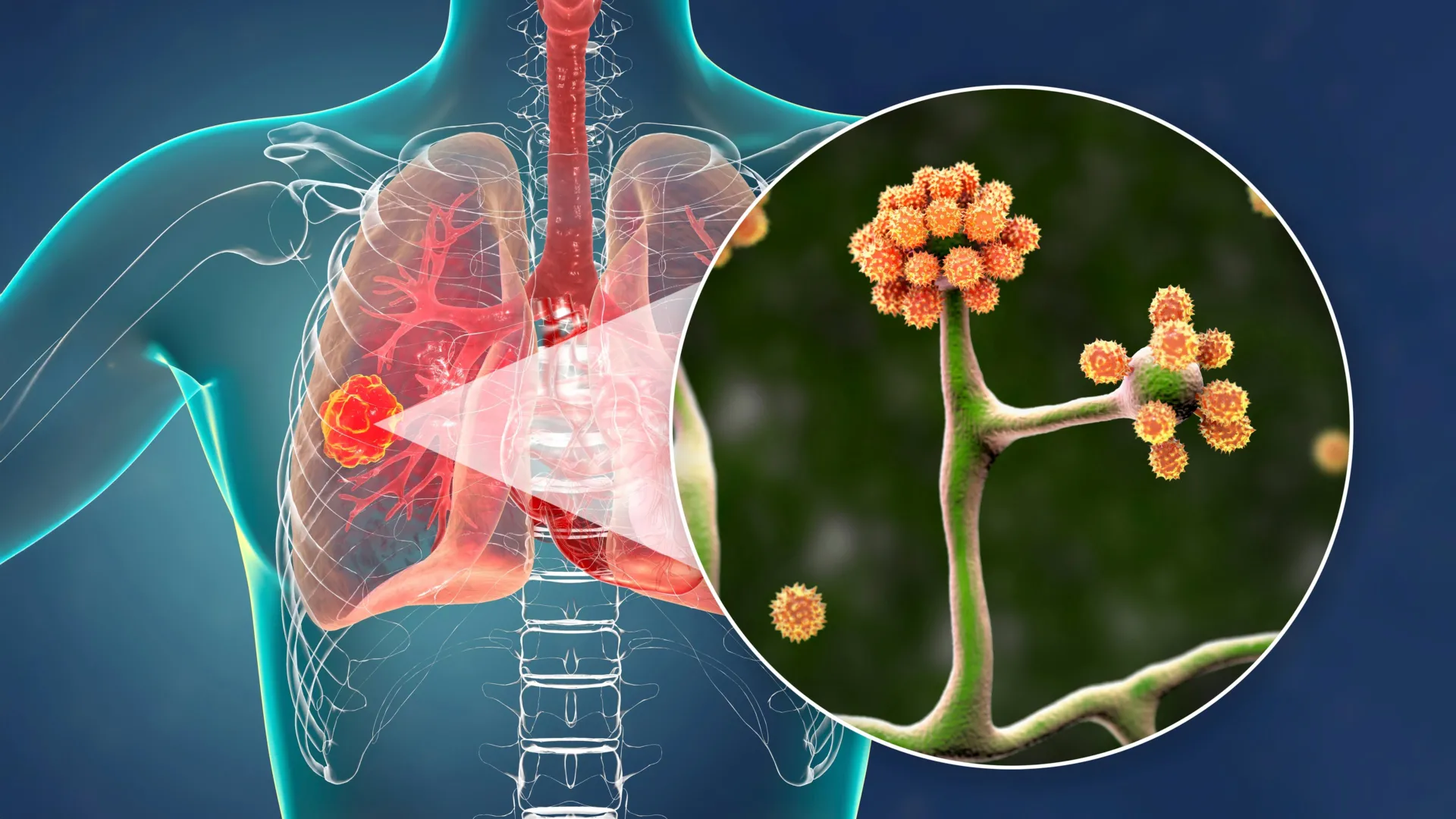 Blood Protein Could Stop Deadly Black Fungus