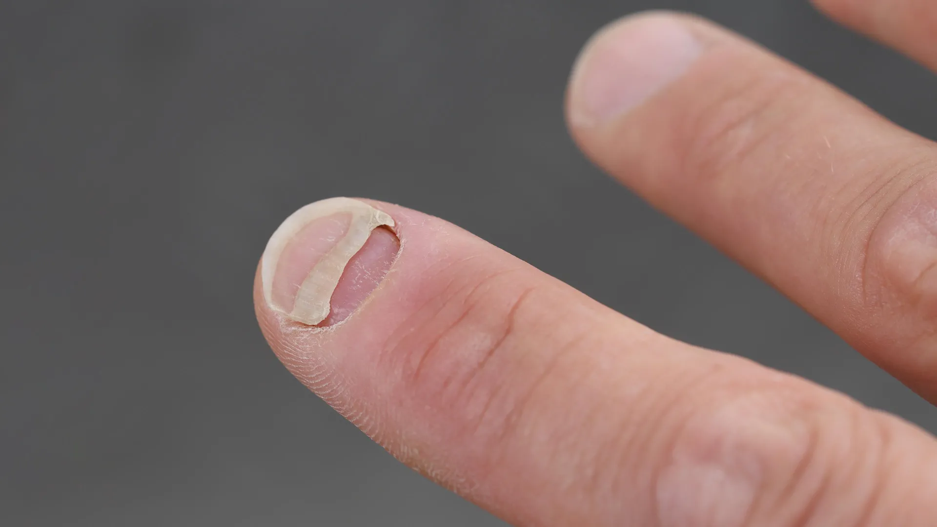 Ozempic Linked to a Strange Nail Problem