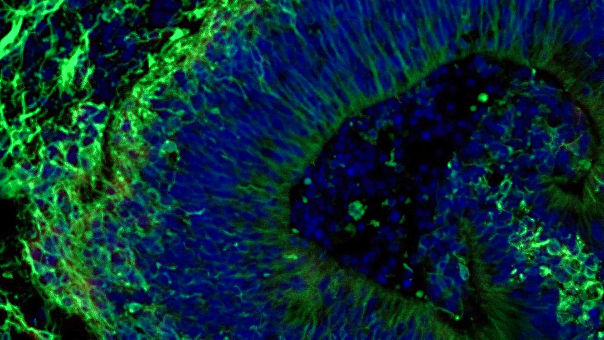 Mini Brains Expose Alzheimer’s Differences