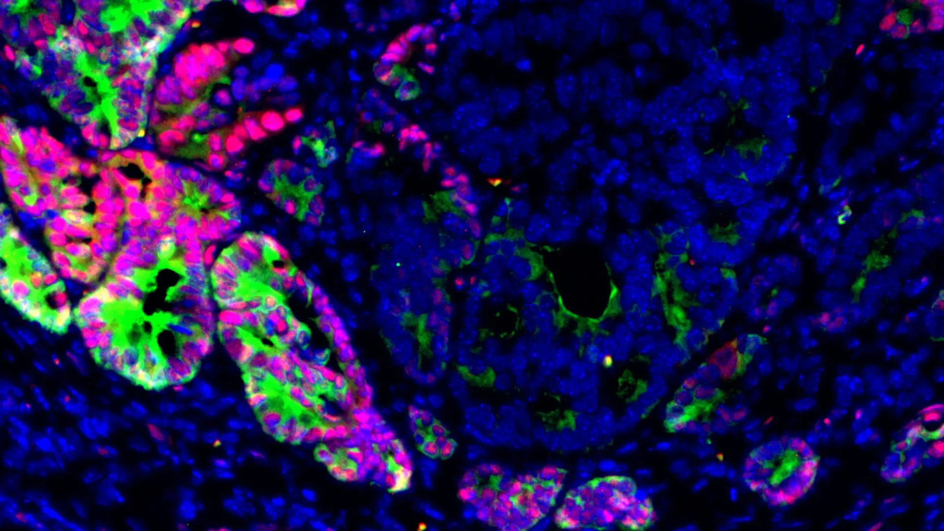 Colon Cancer Cells Change Identity to Spread