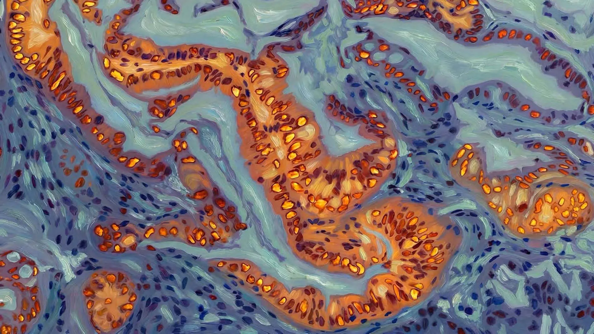 Reversing Chemo Resistance in Pancreatic Cancer