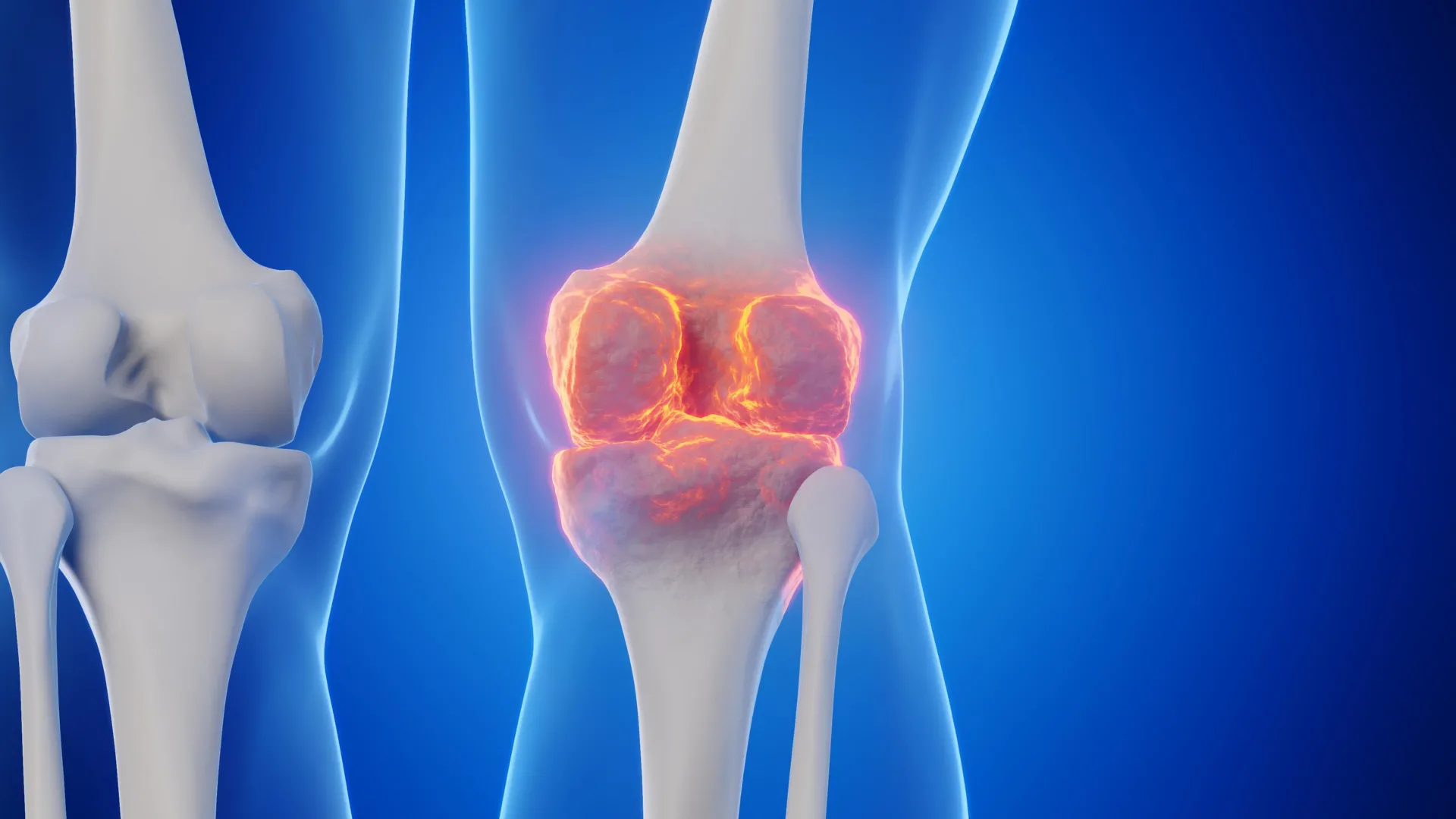 A New Drug Regrows Knee Cartilage