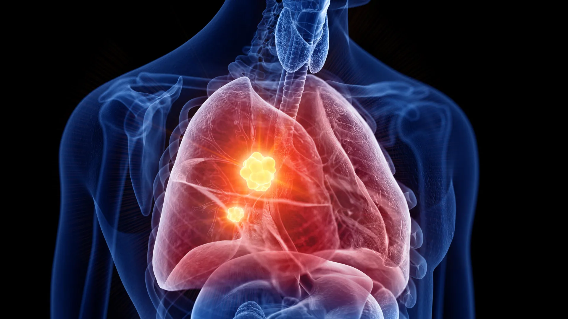 New Drug Targets Mesothelioma’s Weakness