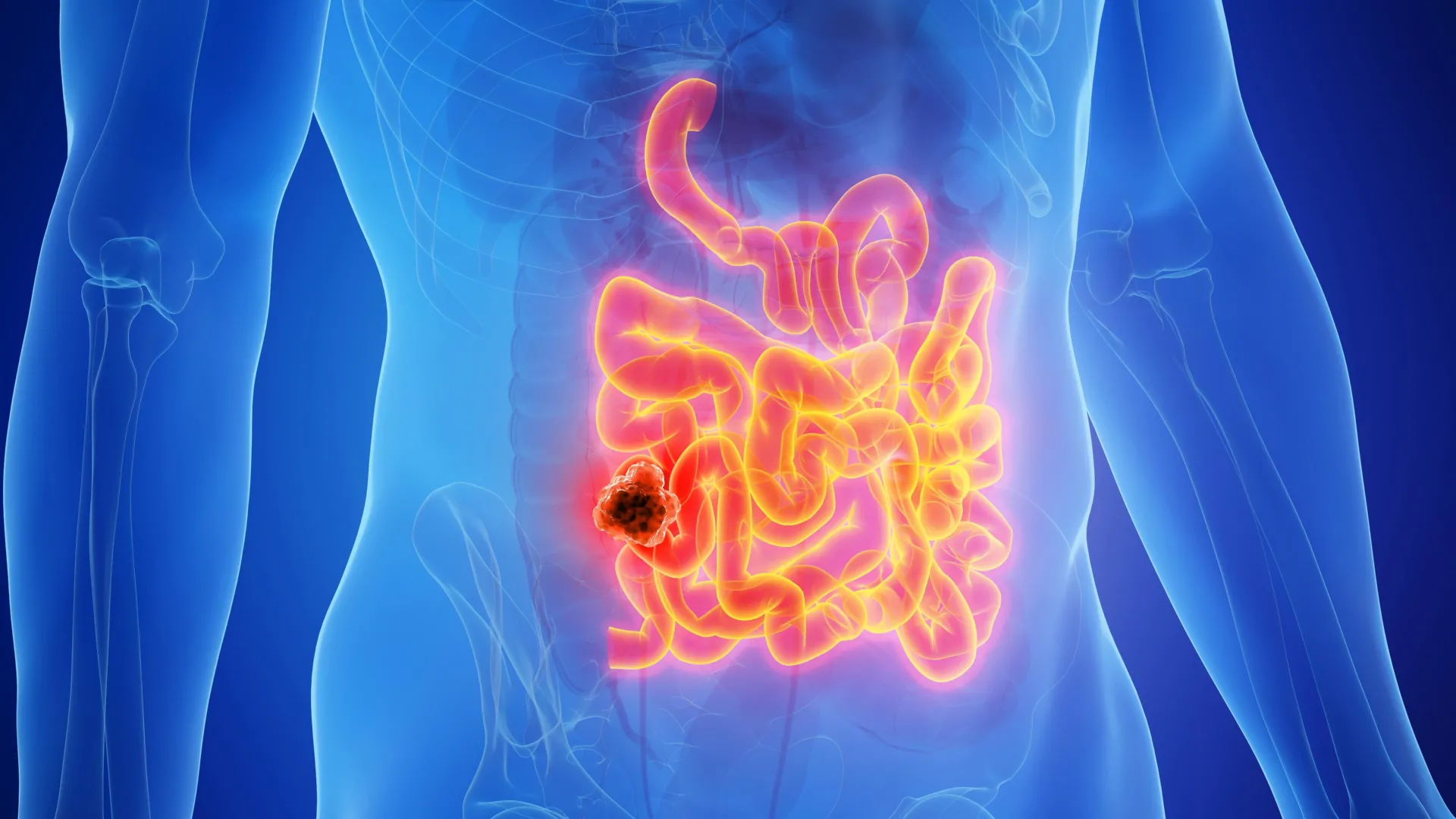 Keto Diet May Raise Cancer Risk