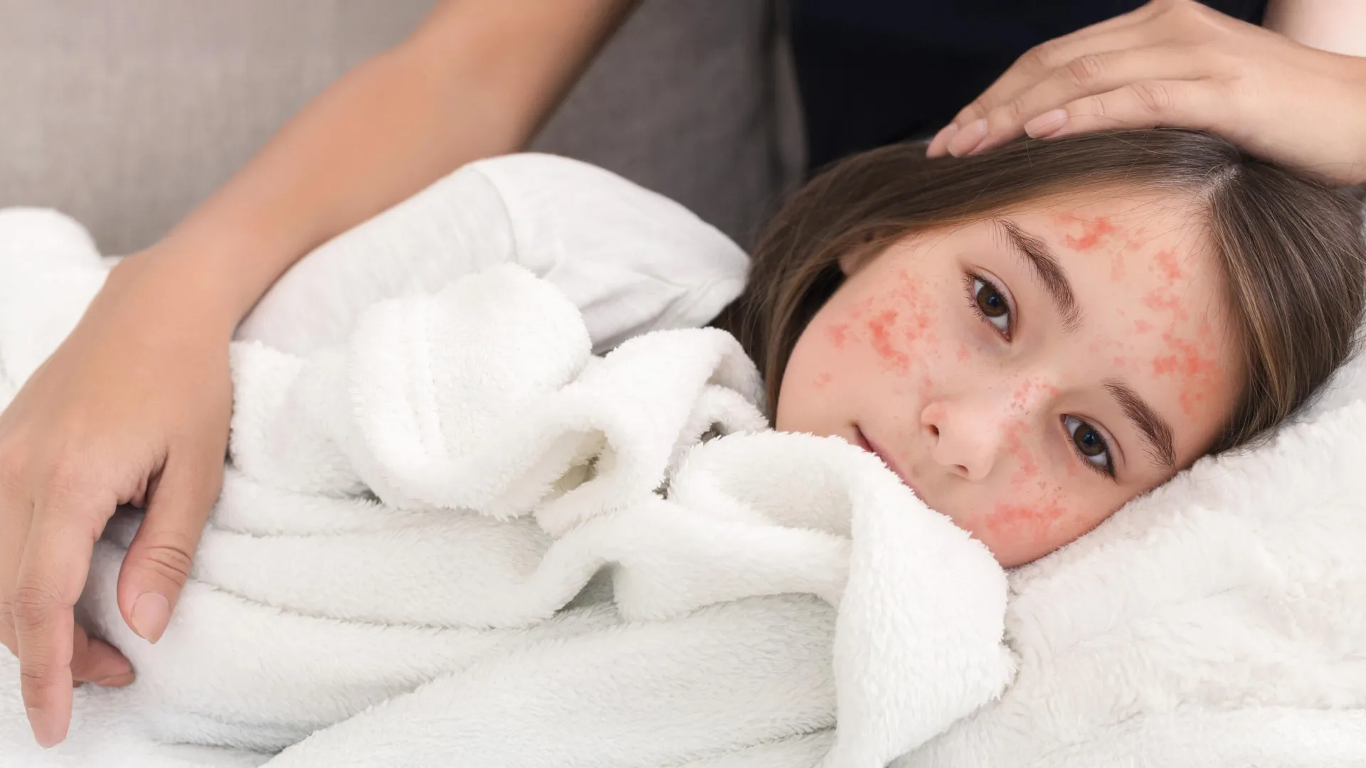 New Antiviral Could Stop Measles Outbreaks