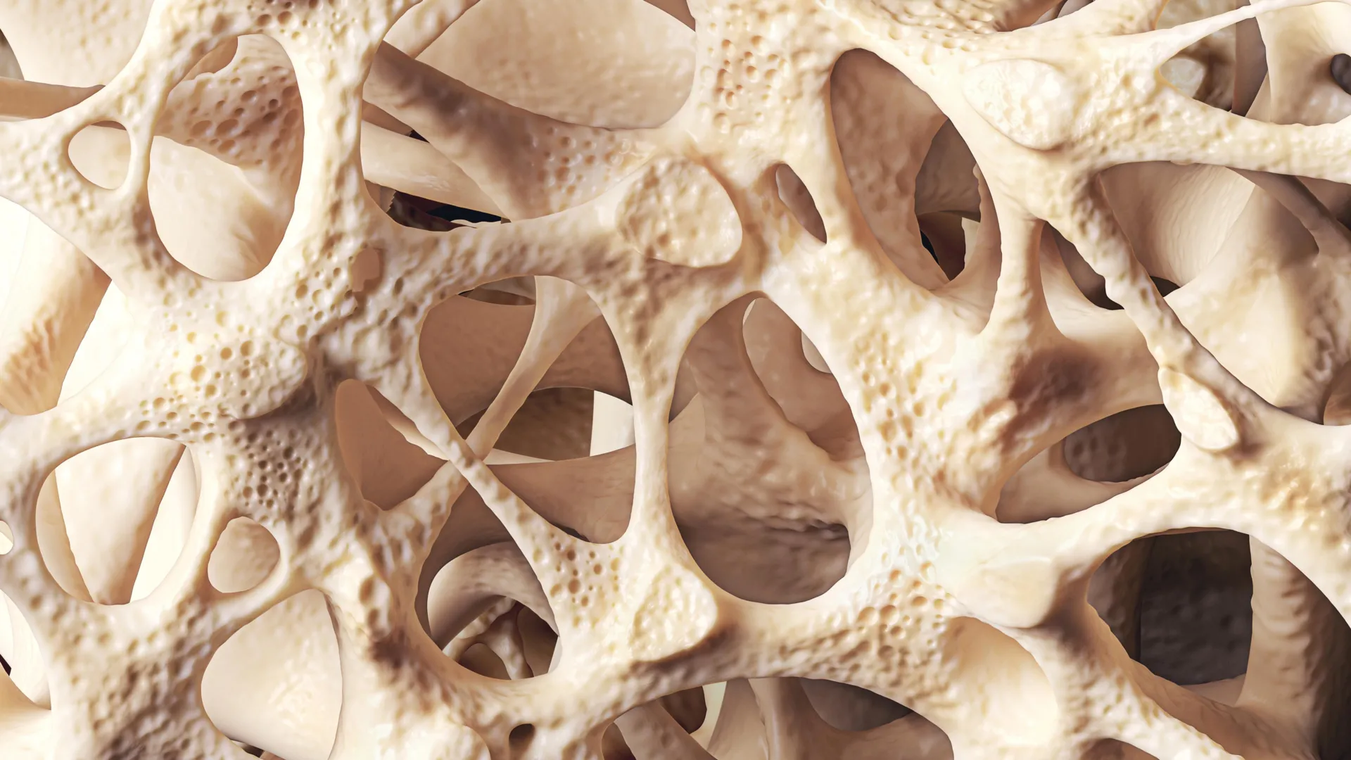 Osteopenia Could Be Weakening Your Bones
