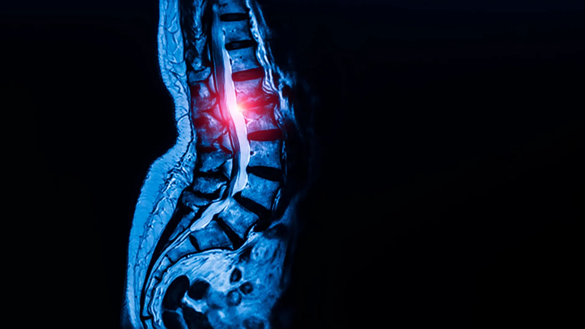 Hidden Stem Cells May Drive Spinal Stenosis
