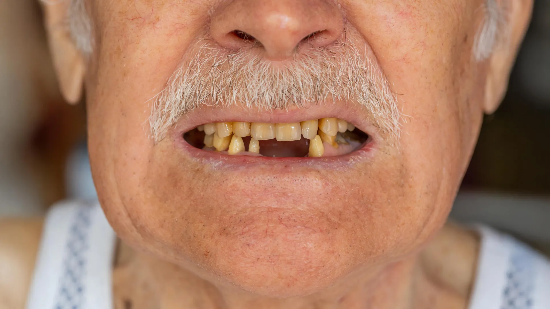 Your Teeth May Predict Cancer Survival