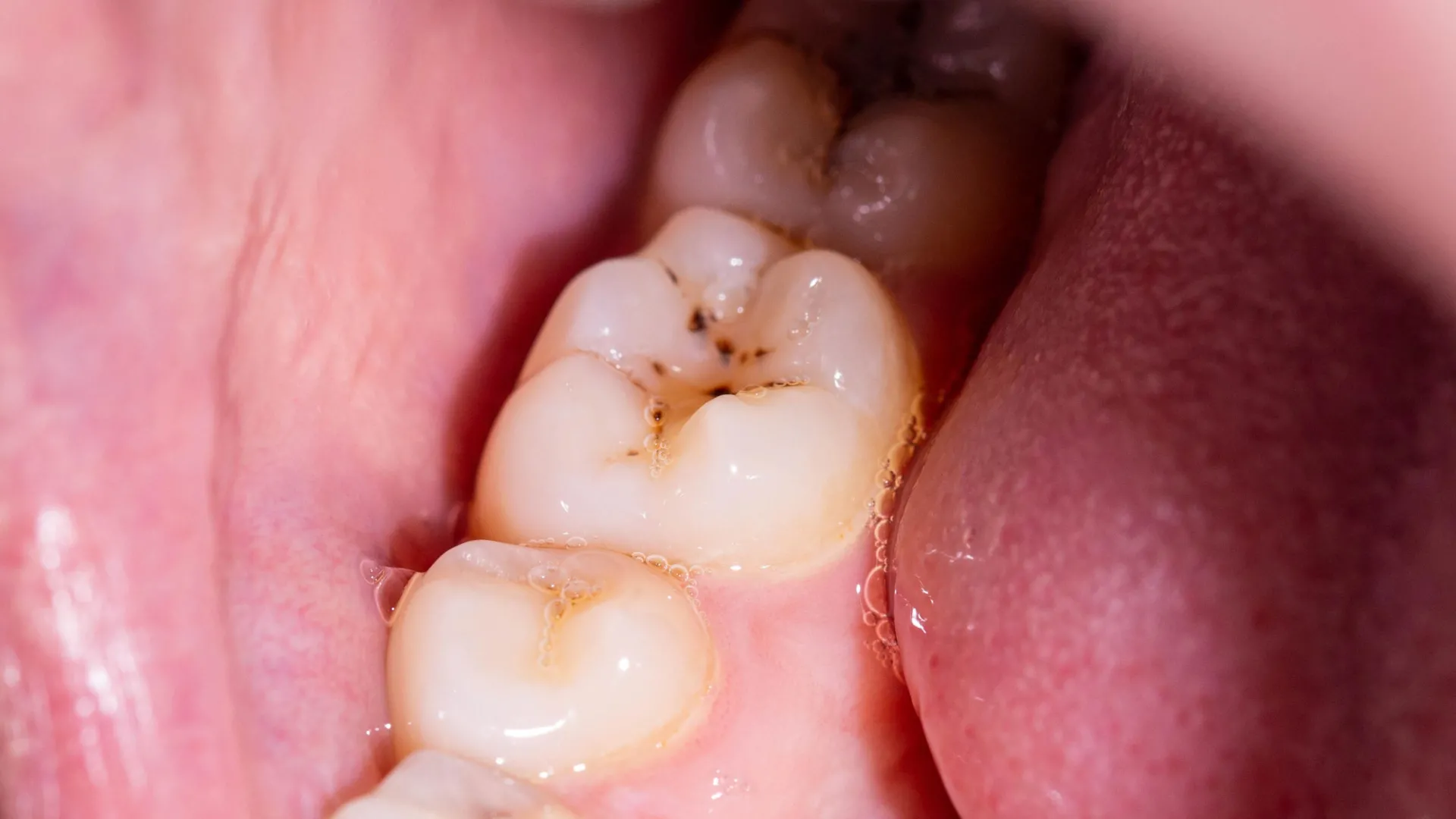 New Gel Could Regrow Tooth Enamel