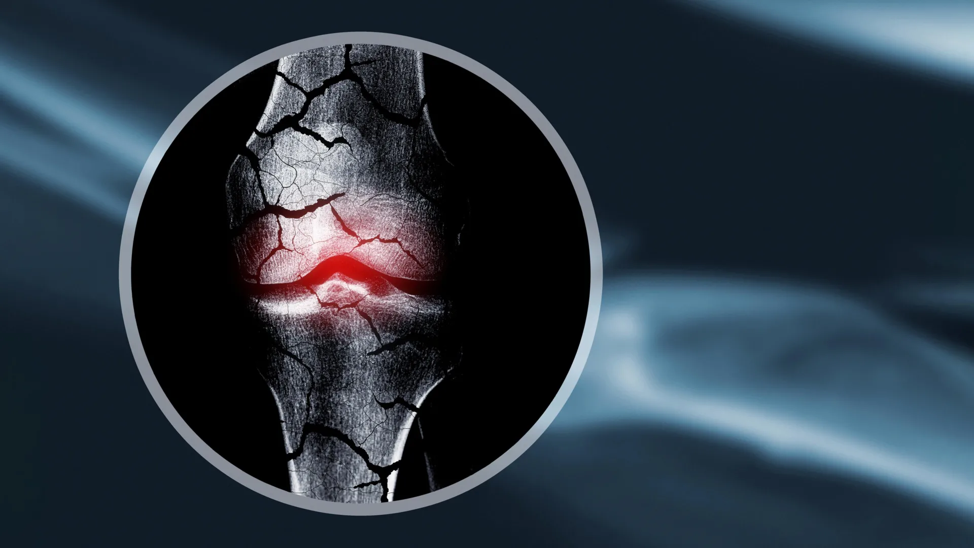 Cartilage Scaffold Helps the Body Regrow Bone